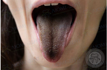 Чорний наліт на язиці