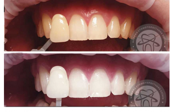 Відбілювання зубів фото робіт до та після - Люмі-Дент