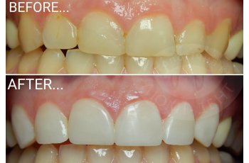 Teeth Restoration Photo Before After Kiev Lumident