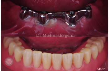 Prosthetic Teeth Photo Before After Kiev Lumi-Dent Prosthetic Teeth Photo Before After Kiev Lumi-Dent