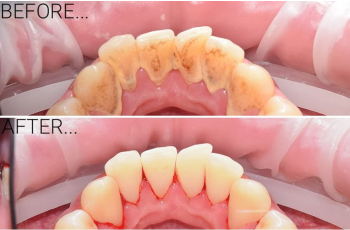 Teeth Cleaning [229 Photos Before After] Kiev Lumi-Dent