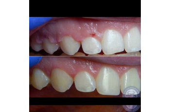 Laser Dentistry [229 Photos Before After] Kiev Lumident