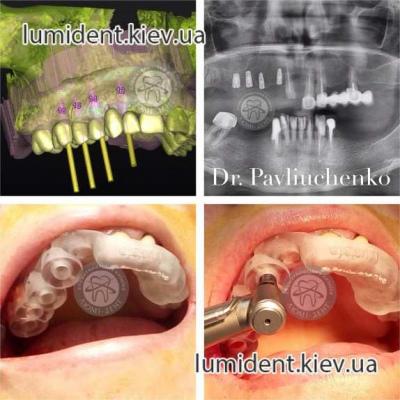 Имплантация зубов видео фото Люми-Дент