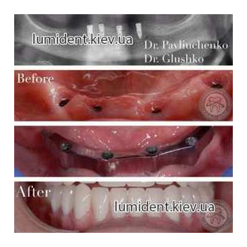 імплантація зубів київ