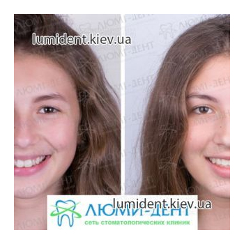 Фото лица до и после брекетов ЛюмиДент