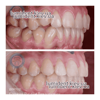 фото до и после исправления прикуса зубов Люми-Дент