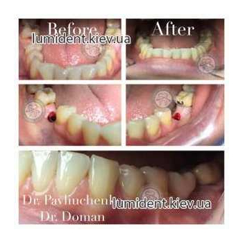 имплантация зубов киев, фото, до и после