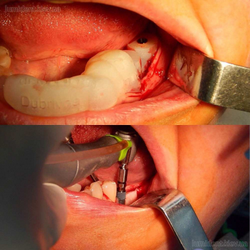 Имплантация зубов с помощью хирургического шаблона