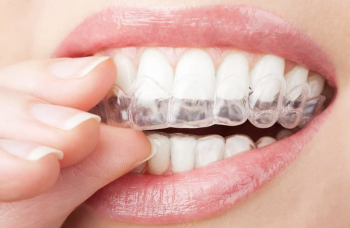 Aligners - the price of aligning teeth with mouth guards in Kyiv